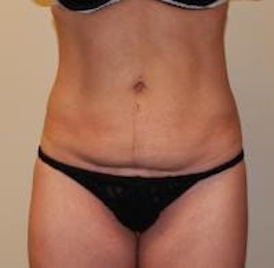 Tummy Tuck Before & After Gallery - Patient 22391067 - Image 1