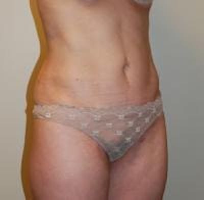 Tummy Tuck Before & After Gallery - Patient 22391067 - Image 4