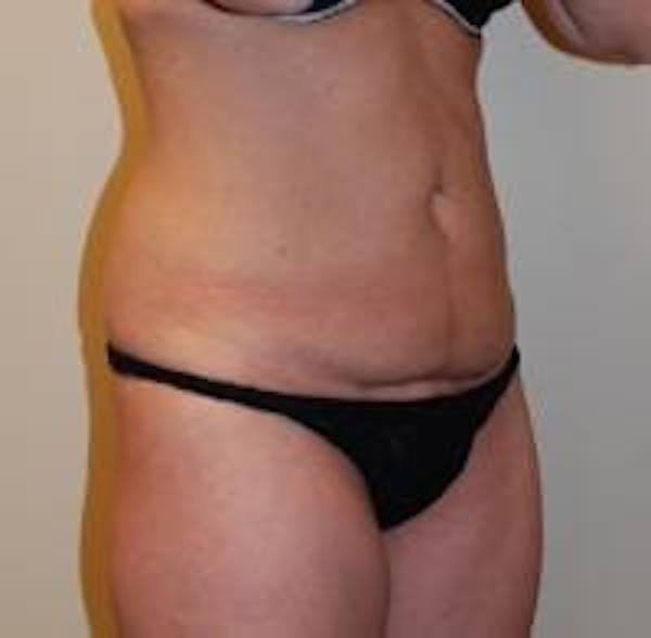 Tummy Tuck Before & After Gallery - Patient 22391067 - Image 3