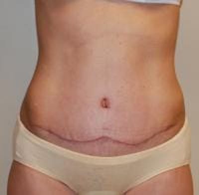 Tummy Tuck Before & After Gallery - Patient 22391068 - Image 2