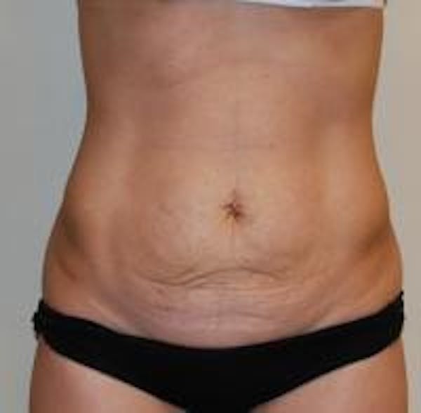 Tummy Tuck Before & After Gallery - Patient 22391068 - Image 1