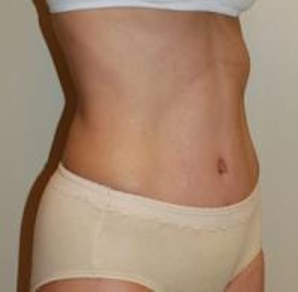 Tummy Tuck Before & After Gallery - Patient 22391068 - Image 4
