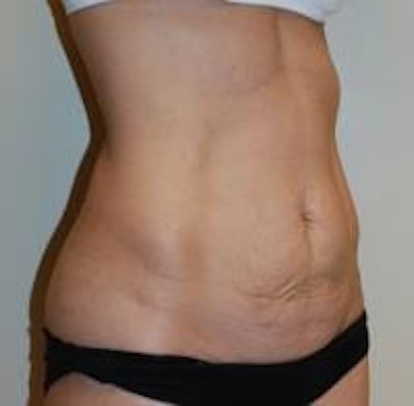 Tummy Tuck Before & After Gallery - Patient 22391068 - Image 3