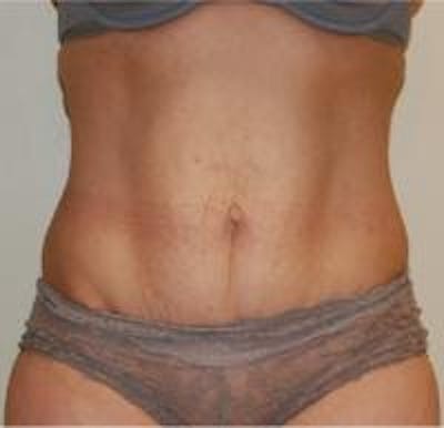 Tummy Tuck Before & After Gallery - Patient 22391069 - Image 1