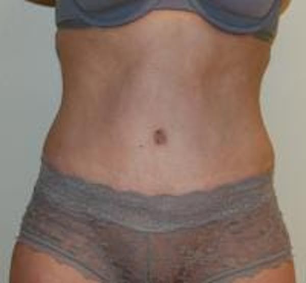 Tummy Tuck Gallery - Patient 22391069 - Image 2