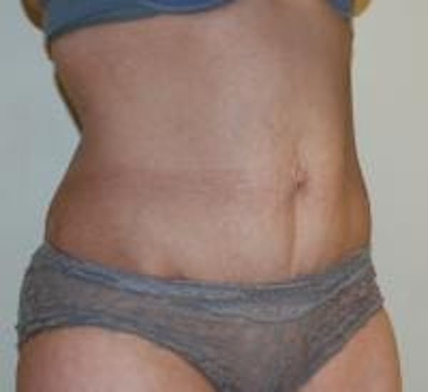 Tummy Tuck Before & After Gallery - Patient 22391069 - Image 3