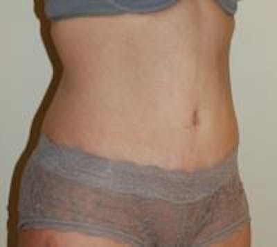 Tummy Tuck Before & After Gallery - Patient 22391069 - Image 4
