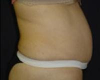 Tummy Tuck Before & After Gallery - Patient 22391070 - Image 2