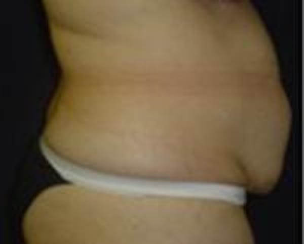 Tummy Tuck Before & After Gallery - Patient 22391070 - Image 1