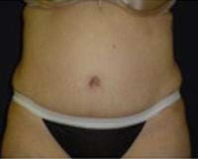 Tummy Tuck Before & After Gallery - Patient 22391070 - Image 4