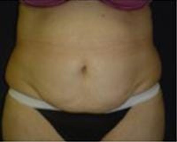 Tummy Tuck Before & After Gallery - Patient 22391070 - Image 3