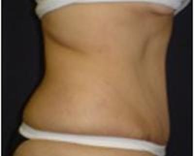 Tummy Tuck Before & After Gallery - Patient 22391071 - Image 2