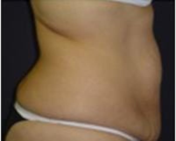Tummy Tuck Before & After Gallery - Patient 22391071 - Image 1