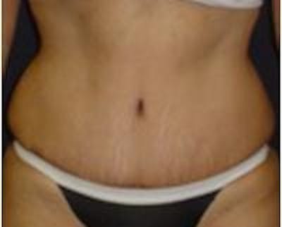 Tummy Tuck Before & After Gallery - Patient 22391071 - Image 4