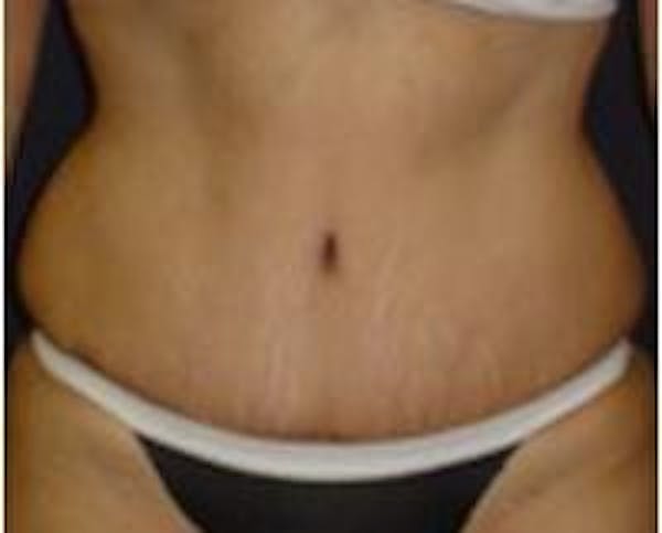 Tummy Tuck Before & After Gallery - Patient 22391071 - Image 4