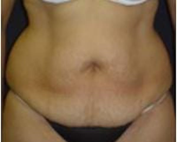 Tummy Tuck Before & After Gallery - Patient 22391071 - Image 3