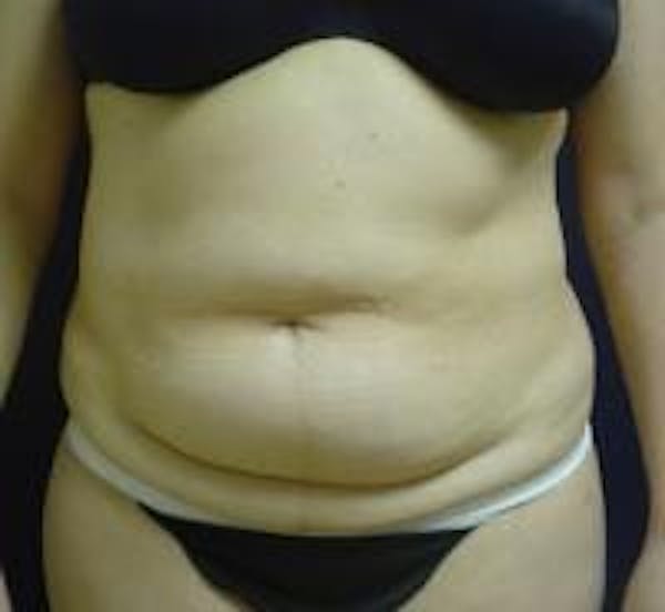 Tummy Tuck Before & After Gallery - Patient 22391072 - Image 1