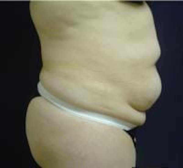 Tummy Tuck Before & After Gallery - Patient 22391072 - Image 3