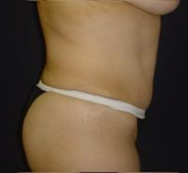 Tummy Tuck Before & After Gallery - Patient 22391072 - Image 4