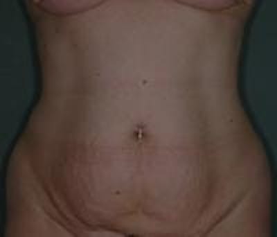 Tummy Tuck Before & After Gallery - Patient 22391073 - Image 1