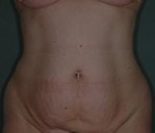 Tummy Tuck Gallery - Patient 22391073 - Image 1