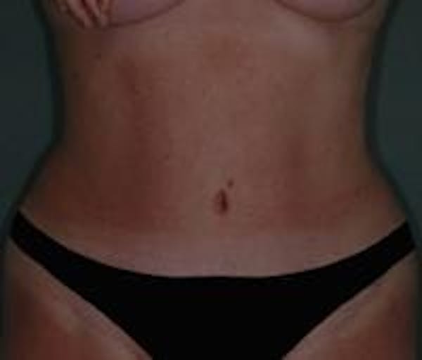 Tummy Tuck Before & After Gallery - Patient 22391073 - Image 2