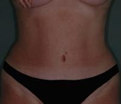 Tummy Tuck Gallery - Patient 22391073 - Image 2