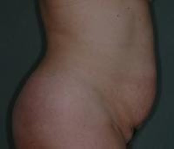 Tummy Tuck Before & After Gallery - Patient 22391073 - Image 3