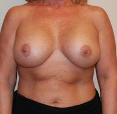 Breast Implant Revision Before & After Gallery - Patient 22391077 - Image 2