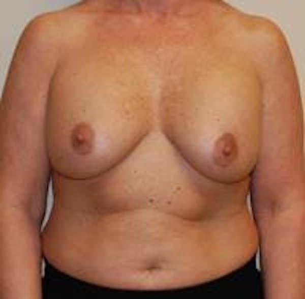 Breast Implant Revision Before & After Gallery - Patient 22391077 - Image 1