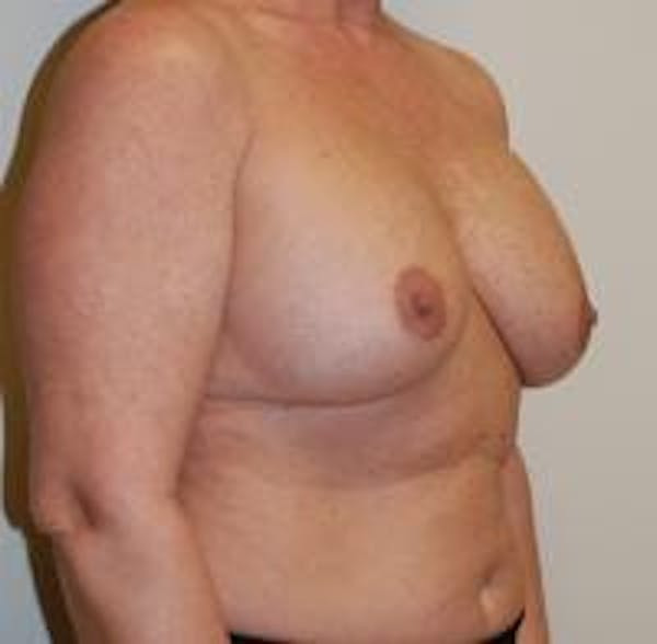 Breast Implant Revision Before & After Gallery - Patient 22391077 - Image 3