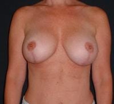 Breast Implant Revision Before & After Gallery - Patient 22391078 - Image 2