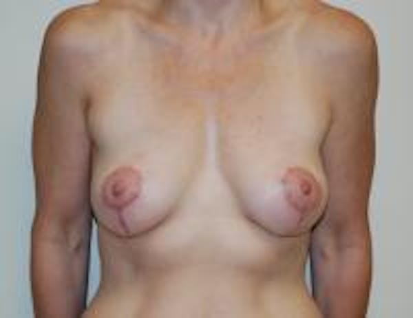 Breast Lift Before & After Gallery - Patient 22391116 - Image 2