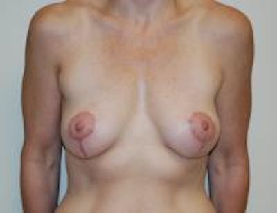 Breast Lift Before & After Gallery - Patient 22391116 - Image 2
