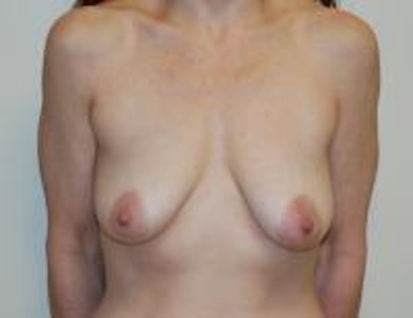 Breast Lift Before & After Gallery - Patient 22391116 - Image 1
