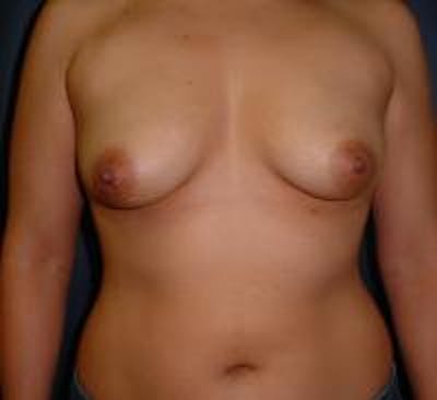 Breast Lift with Augmentation Before & After Gallery - Patient 22391135 - Image 1