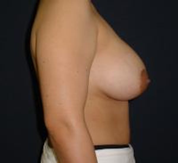 Breast Lift with Augmentation Before & After Gallery - Patient 22391135 - Image 4