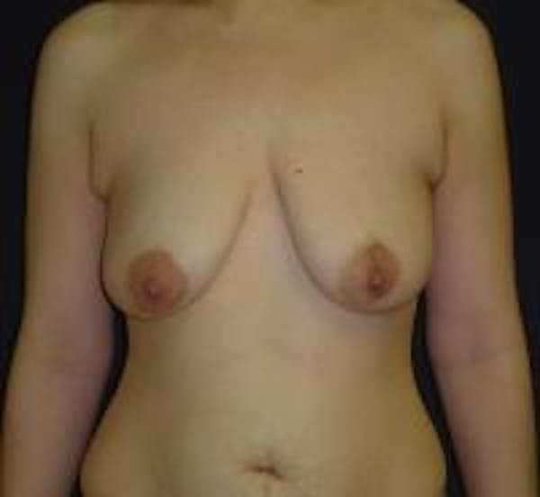 Breast Lift with Augmentation Before & After Gallery - Patient 22391137 - Image 1