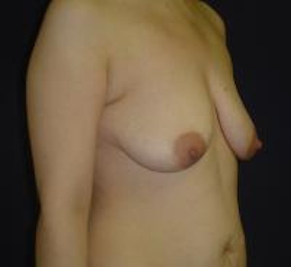 Breast Lift with Augmentation Before & After Gallery - Patient 22391137 - Image 3