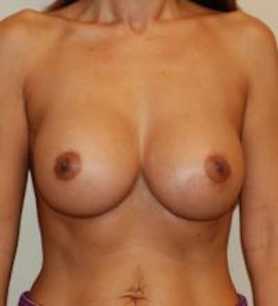 Breast Augmentation Before & After Gallery - Patient 22391248 - Image 2