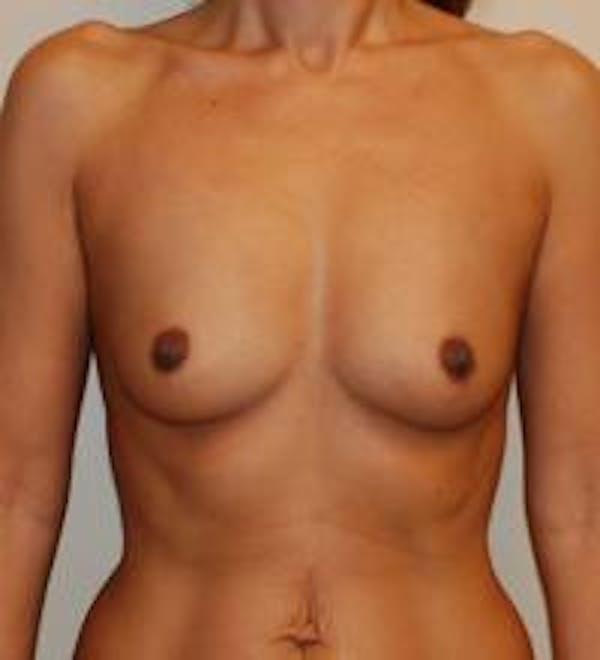 Breast Augmentation Before & After Gallery - Patient 22391248 - Image 1