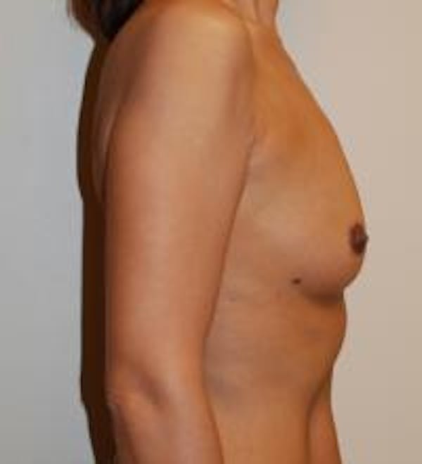 Breast Augmentation Before & After Gallery - Patient 22391248 - Image 3