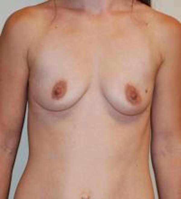 Breast Augmentation Before & After Gallery - Patient 22391249 - Image 1