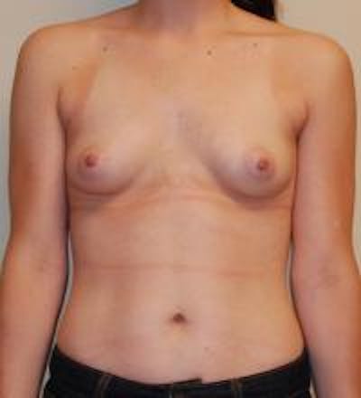 Breast Augmentation Before & After Gallery - Patient 22391250 - Image 1