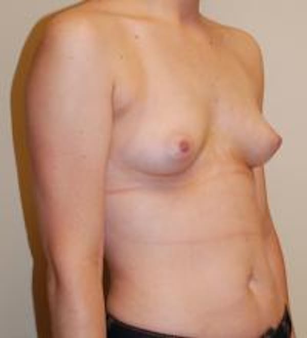 Breast Augmentation Before & After Gallery - Patient 22391250 - Image 3