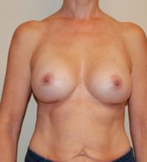 Breast Augmentation Before & After Gallery - Patient 22391251 - Image 2