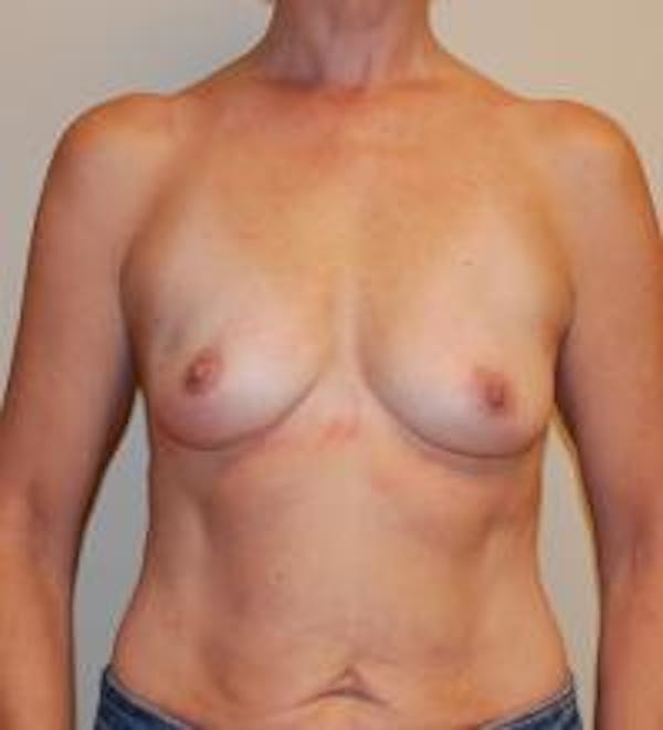 Breast Augmentation Before & After Gallery - Patient 22391251 - Image 1