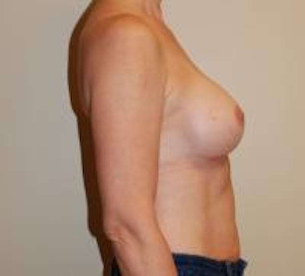 Breast Augmentation Gallery - Patient 22391251 - Image 4