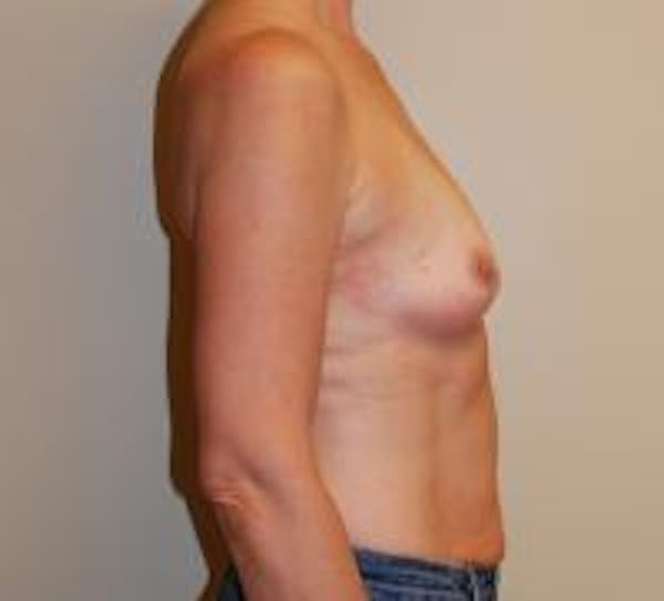 Breast Augmentation Before & After Gallery - Patient 22391251 - Image 3
