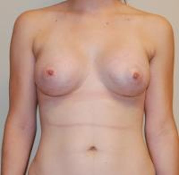 Breast Augmentation Before & After Gallery - Patient 22391252 - Image 2